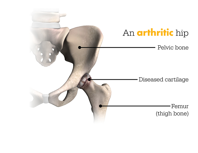 An Arthritic Hip An Arthritic Hip