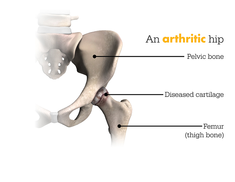 An arthritic hip