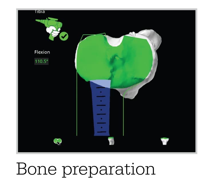 Mako Bone prep